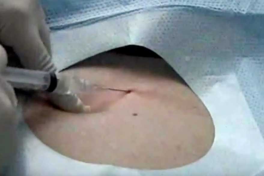 Gastrostomía GOODMAN