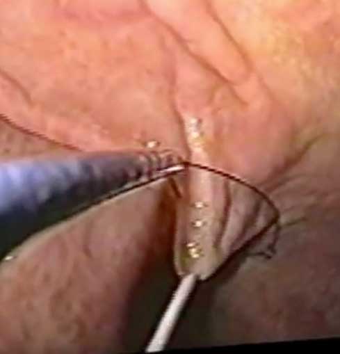 Gastrostomía procedimiento