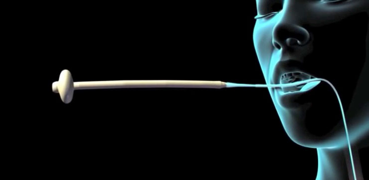 Introducción de la sonda por boca