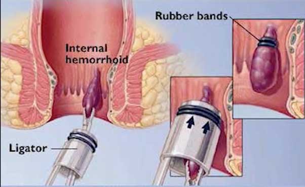 Ligadura de hemorroides GOODMAN