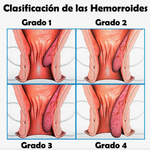 Ligadura de hemorroides — imagen 5