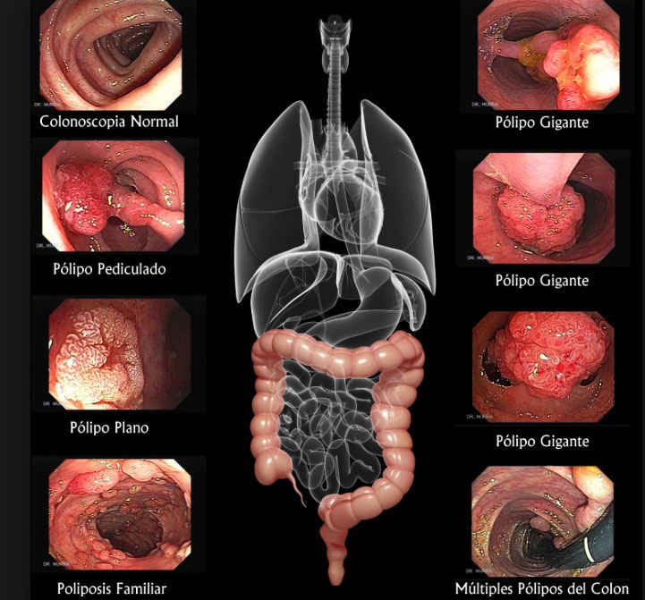 Resección de pólipo GOODMAN