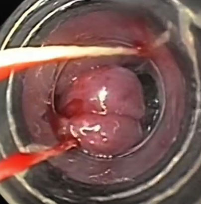 Ligadura de Várices GOODMAN